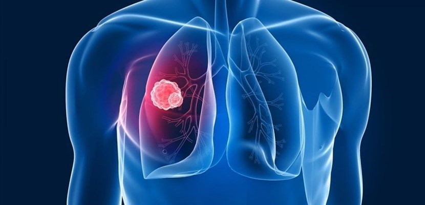 Mesotelioma pleurico, se ne parla a Taranto Mesotelioma pleurico, se ne parla a Taranto